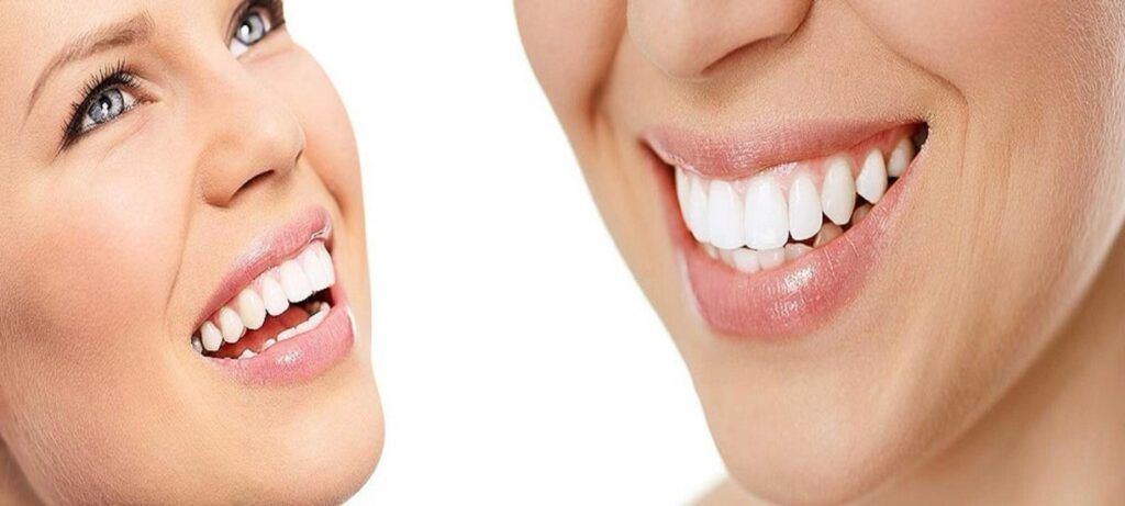Teeth Bleaching Services: Understanding the Cost and Value for Your Smile