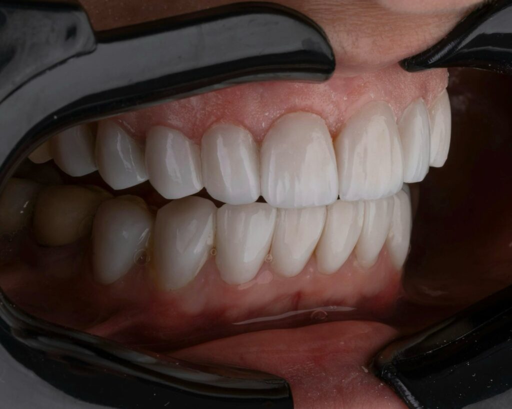 How to Recognize Early Signs of Receding Gums