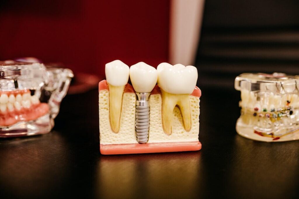 The Complete Guide to Front Dental Implants: What You Need to Know