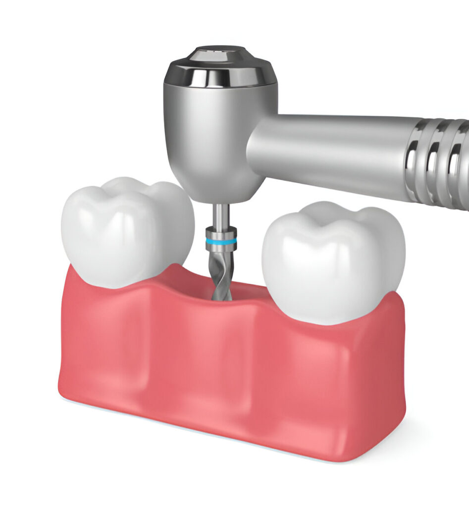 Dental Implants: The Key to Restoring Functionality and Beauty