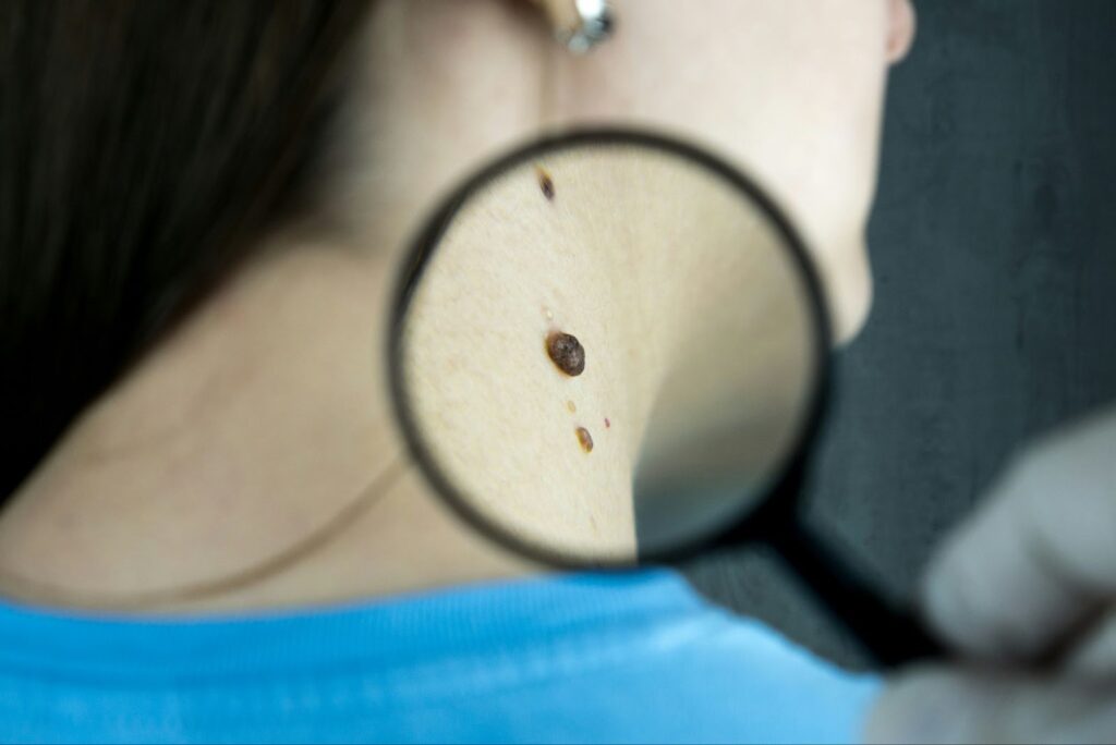 Skin Cancer Treatment