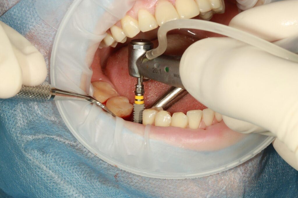 The Ultimate Guide to Tooth Replacement Options: Choosing What's Right for You