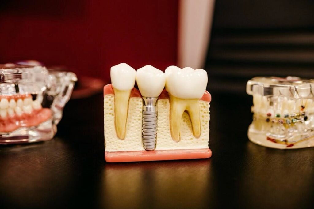 Best Tooth Replacement Options: Find the Right Solution for Your Smile