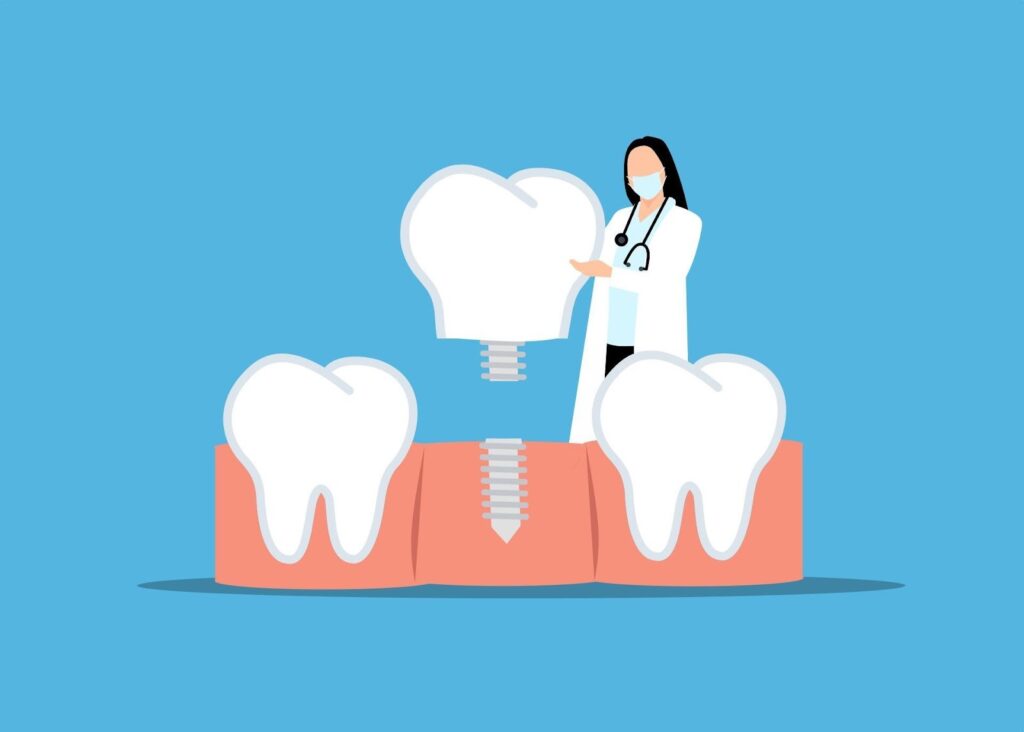 Evolution of Dental Implants