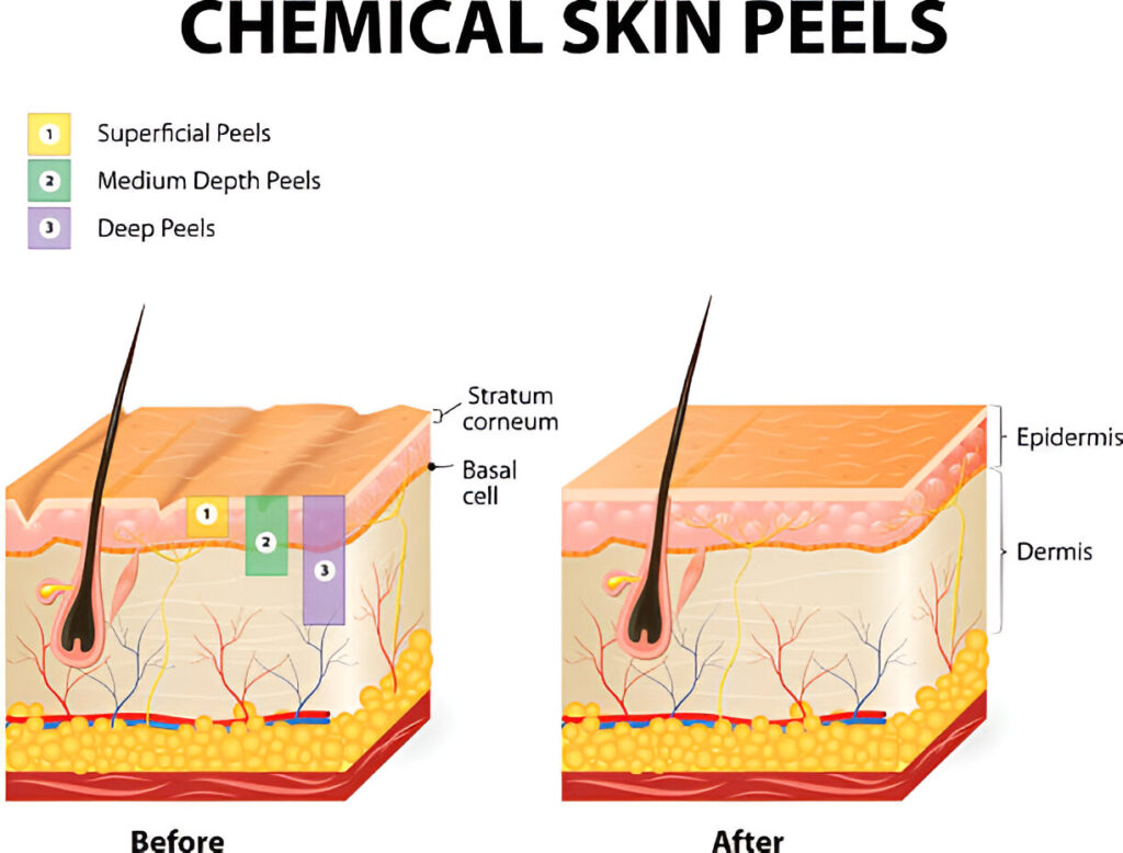 Science Behind Chemical Peels