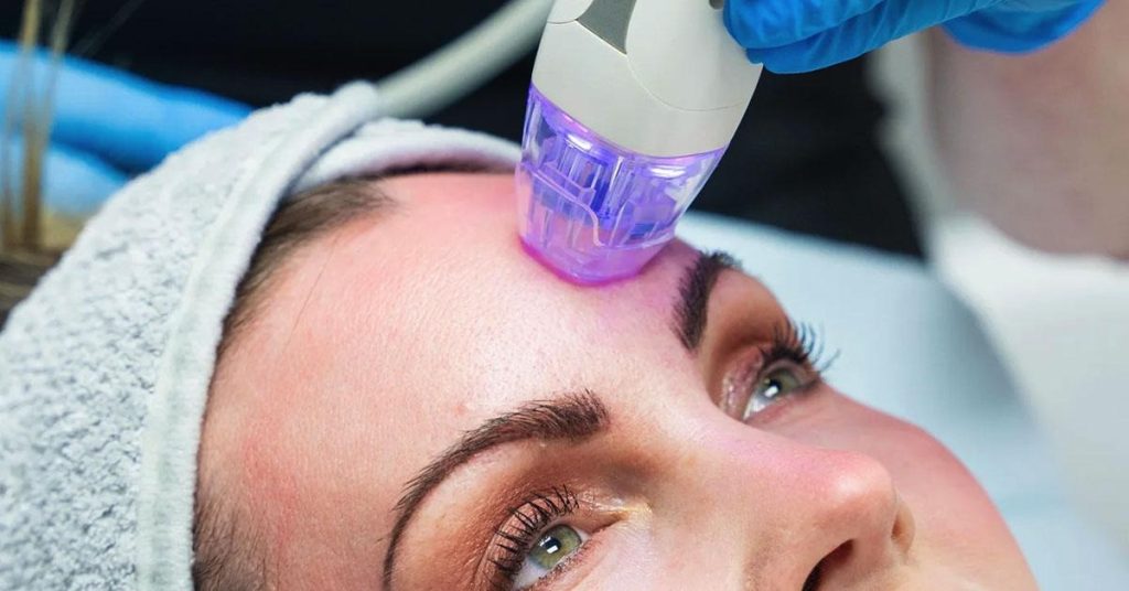 Beauty Trends: Microneedling as the Latest Cosmetic Craze in Brisbane Beauty Trends