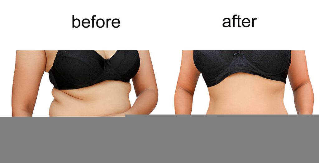 Liposuction vs. Non-Surgical Fat Removal