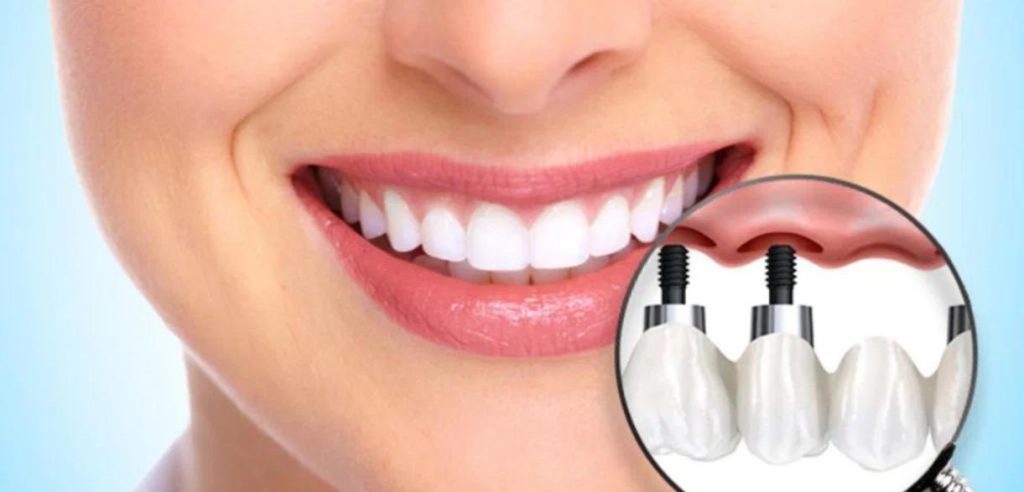 Revolutionising Smiles