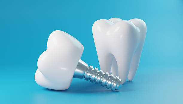 3 Key Advantages Of Immediate Load Dental Implants Immediate Load Dental Implants
