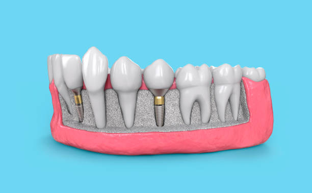 Why Dental Implants Are A Permanent Solution For Missing Teeth Missing Teeth